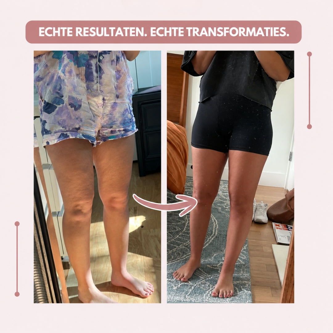 CelluSlim 3D Anti-Lipoedema Leggings – Compression &amp; Comfort