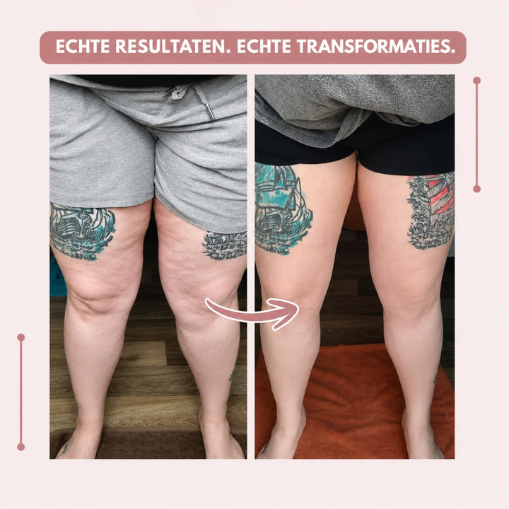 CelluSlim 3D Anti-Lipoedema Leggings – Compression &amp; Comfort